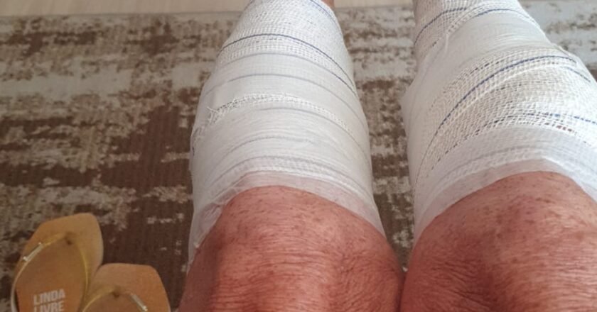 Mulher mordida por cães na praia em Passo de Torres se recupera em Farroupilha, RS.